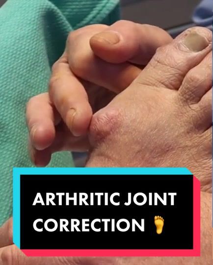 Video post by @bunionking1 on TikTok