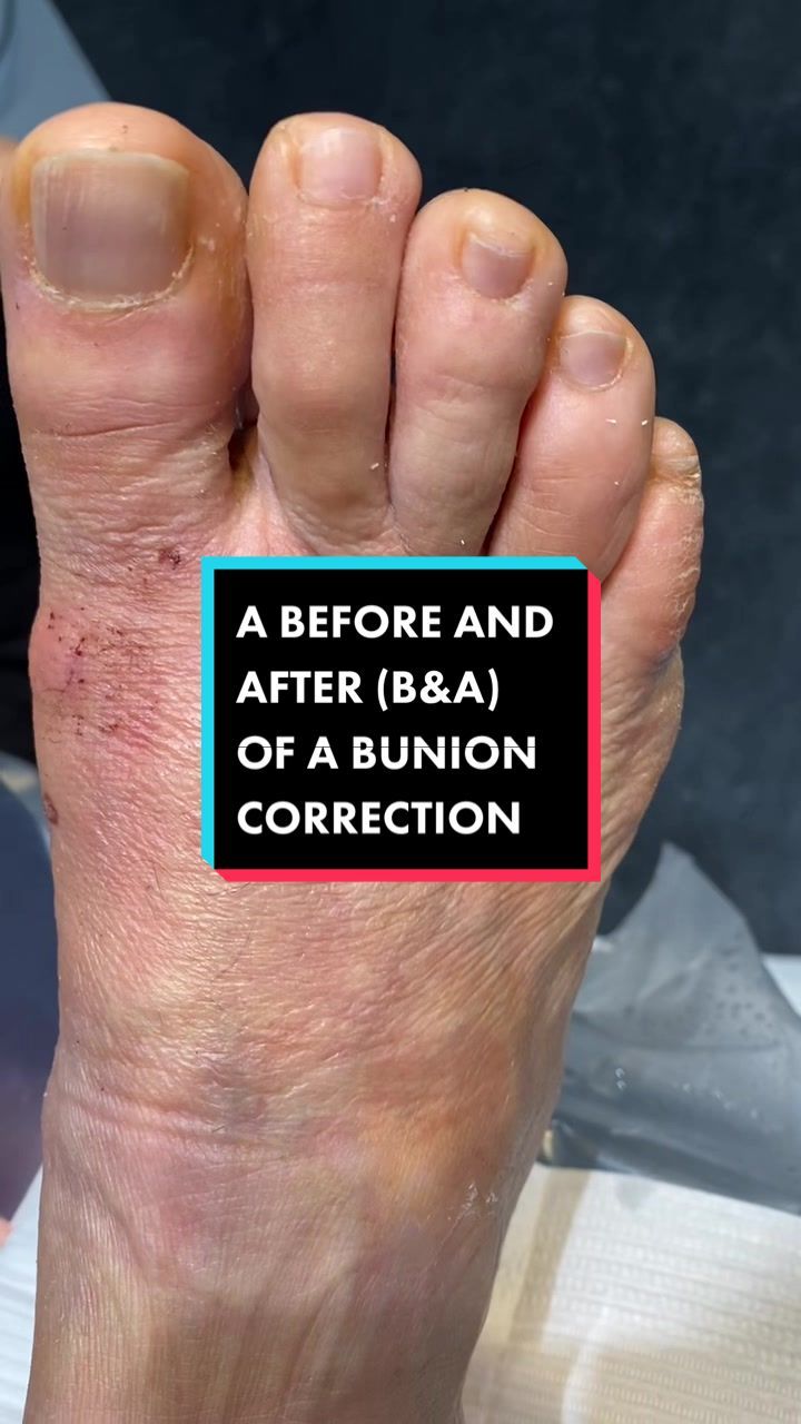 Video post by @bunionking1 on TikTok