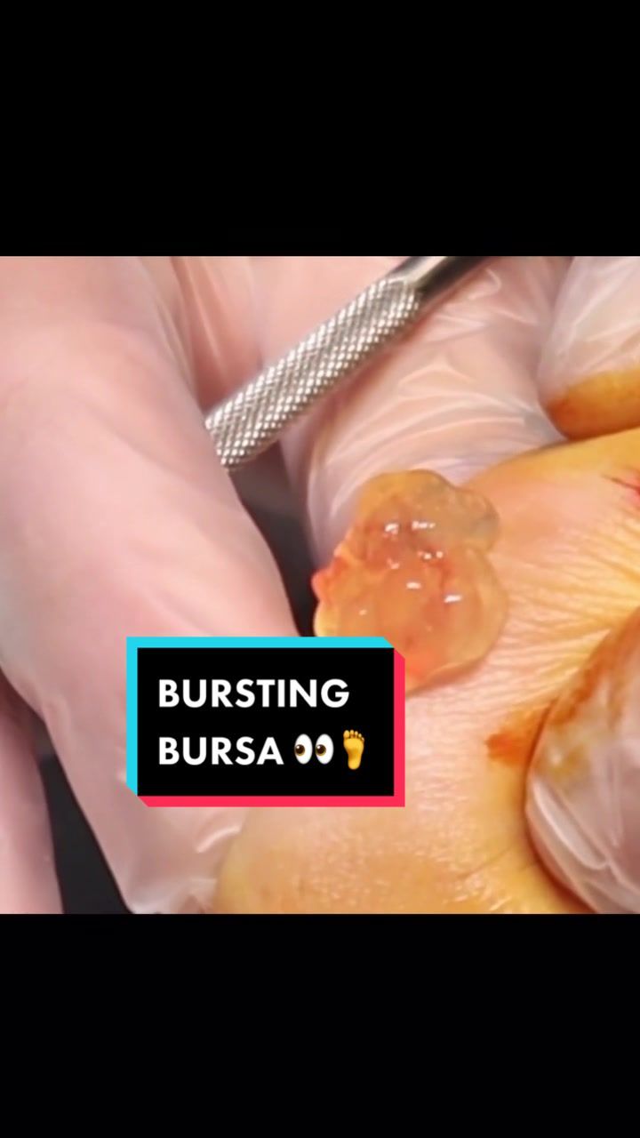 Video post by @bunionking1 on TikTok