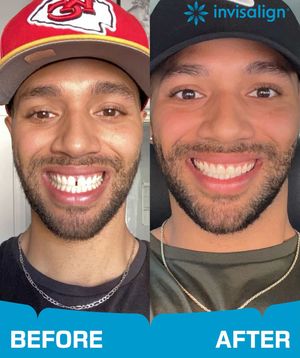 Image post by @invisalign on Instagram