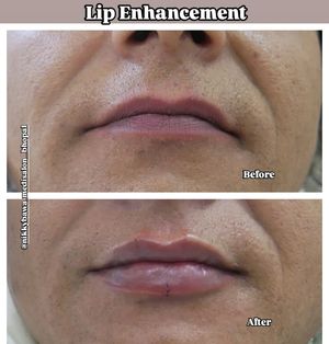 Image post by @nikkybawamedisalonbhopal on Instagram