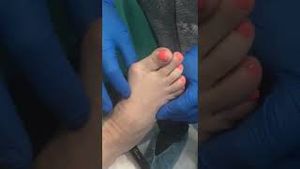 Video post by @thebunionking on YouTube