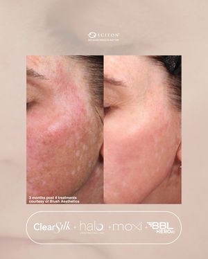 Image post by @sciton_inc on Instagram