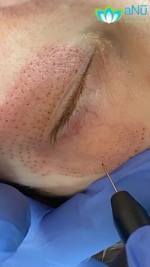 Video post by @anuaestheticsandwellness on Instagram