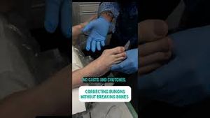 Video post by @thebunionking on YouTube