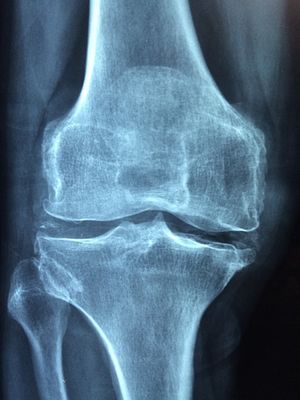 Image post by @PiedmontArthritisClinic on Facebook