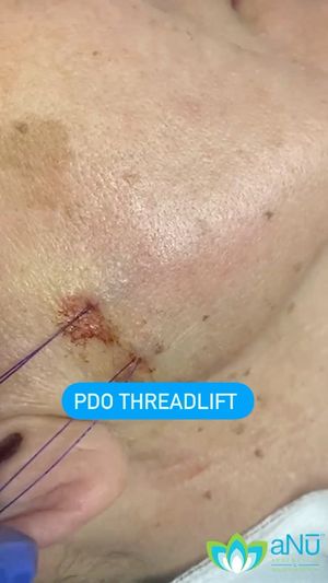 Video post by @anuaestheticsandwellness on Instagram