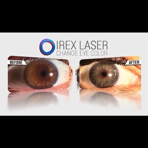 Image post by @irexlaser on Instagram