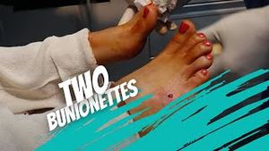 Video post by @thebunionking on YouTube