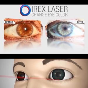 Image post by @irexlaser on Instagram