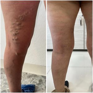 Image post by @dr.vicentevascular on Instagram