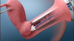Video post by @nucleusmedicalmedia on YouTube