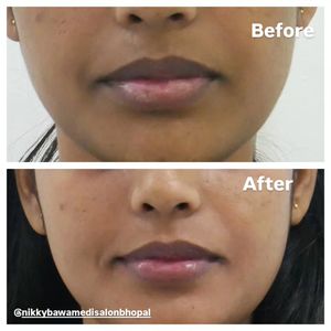 Image post by @nikkybawamedisalonbhopal on Instagram