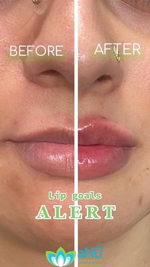 Video post by @anuaestheticsandwellness on Instagram