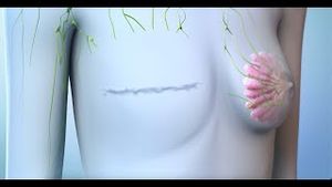 Video post by @nucleusmedicalmedia on YouTube