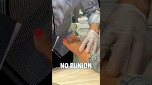 Video post by @thebunionking on YouTube