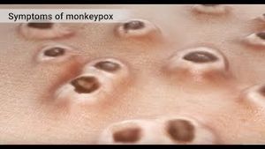 Video post by @nucleusmedicalmedia on YouTube