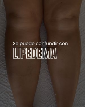 Image post by @lipedema.su on Instagram