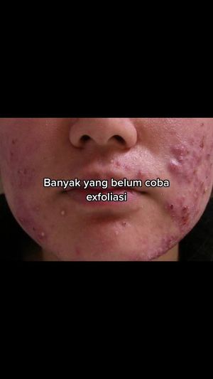 Video post by @lili.refliskin on TikTok