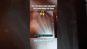 Video post by @thebunionking on YouTube