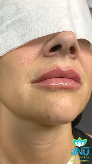 Video post by @anuaestheticsandwellness on Instagram