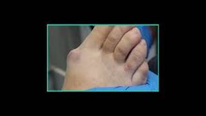 Video post by @thebunionking on YouTube