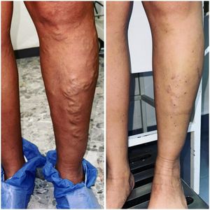 Image post by @dr.vicentevascular on Instagram