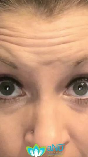 Video post by @anuaestheticsandwellness on Instagram