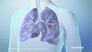 Video post by @nucleusmedicalmedia on YouTube