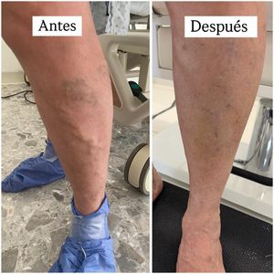 Image post by @dr.vicentevascular on Instagram