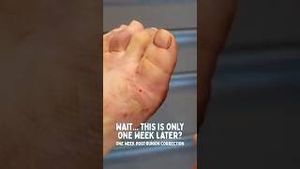 Video post by @thebunionking on YouTube