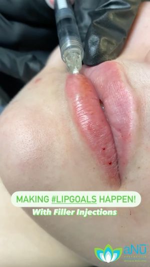 Video post by @anuaestheticsandwellness on Instagram