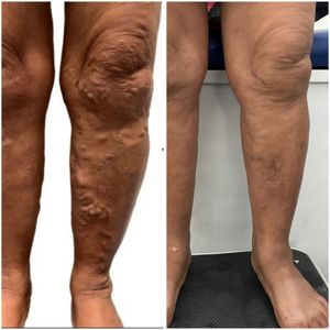 Image post by @dr.vicentevascular on Instagram