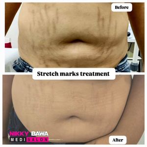 Image post by @nikkybawamedisalonbhopal on Instagram