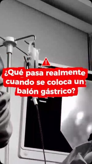 Video post by @balongastricointernacional on Instagram
