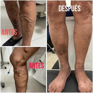 Image post by @dr.vicentevascular on Instagram