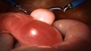 Video post by @nucleusmedicalmedia on YouTube