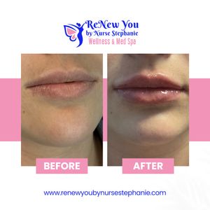 Image post by @renewyoubynursestephanie on Instagram