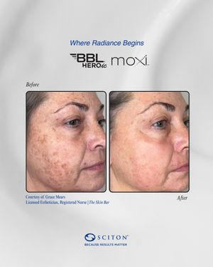 Image post by @sciton_inc on Instagram