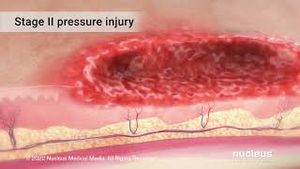 Video post by @nucleusmedicalmedia on YouTube