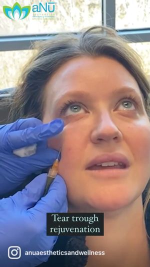 Video post by @anuaestheticsandwellness on Instagram