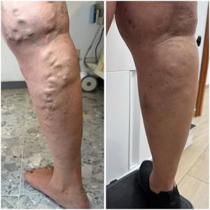 Image post by @dr.vicentevascular on Instagram