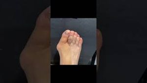 Video post by @thebunionking on YouTube