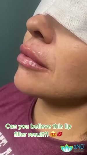 Video post by @anuaestheticsandwellness on Instagram