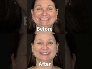 Video post by @cedarvillagedentistry on YouTube