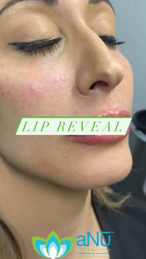 Video post by @anuaestheticsandwellness on Instagram