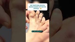 Video post by @thebunionking on YouTube