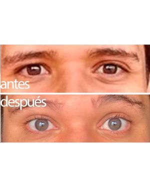 Image post by @irexlaser on Instagram