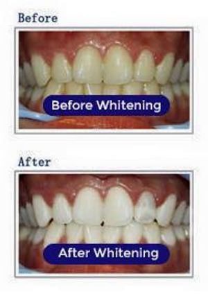 Image post by @perfectsmileswhitening on Facebook