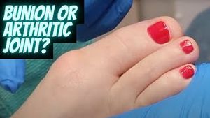 Video post by @thebunionking on YouTube